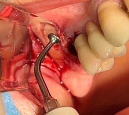Maîtriser les comblements sinusiens avec la PiezoChirurgie