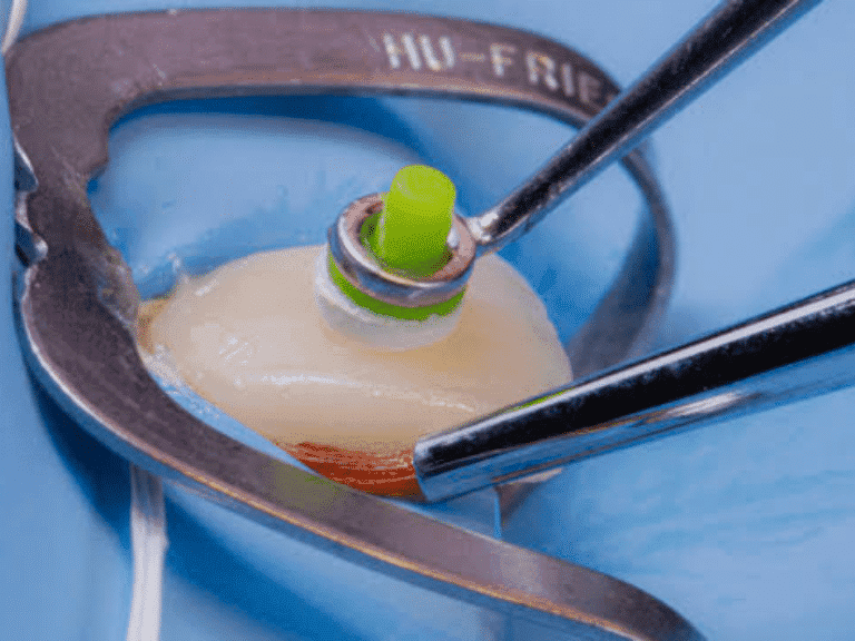 Facettes en céramique collée : de l’indication au collage, une approche biomimétique et minimalement invasive