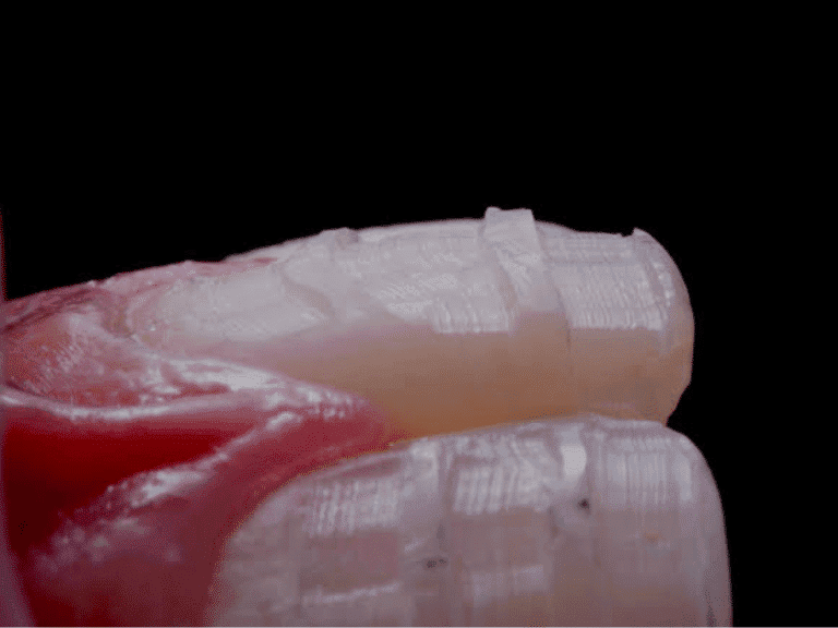 Facettes en céramique collée : de l’indication au collage, une approche biomimétique et minimalement invasive